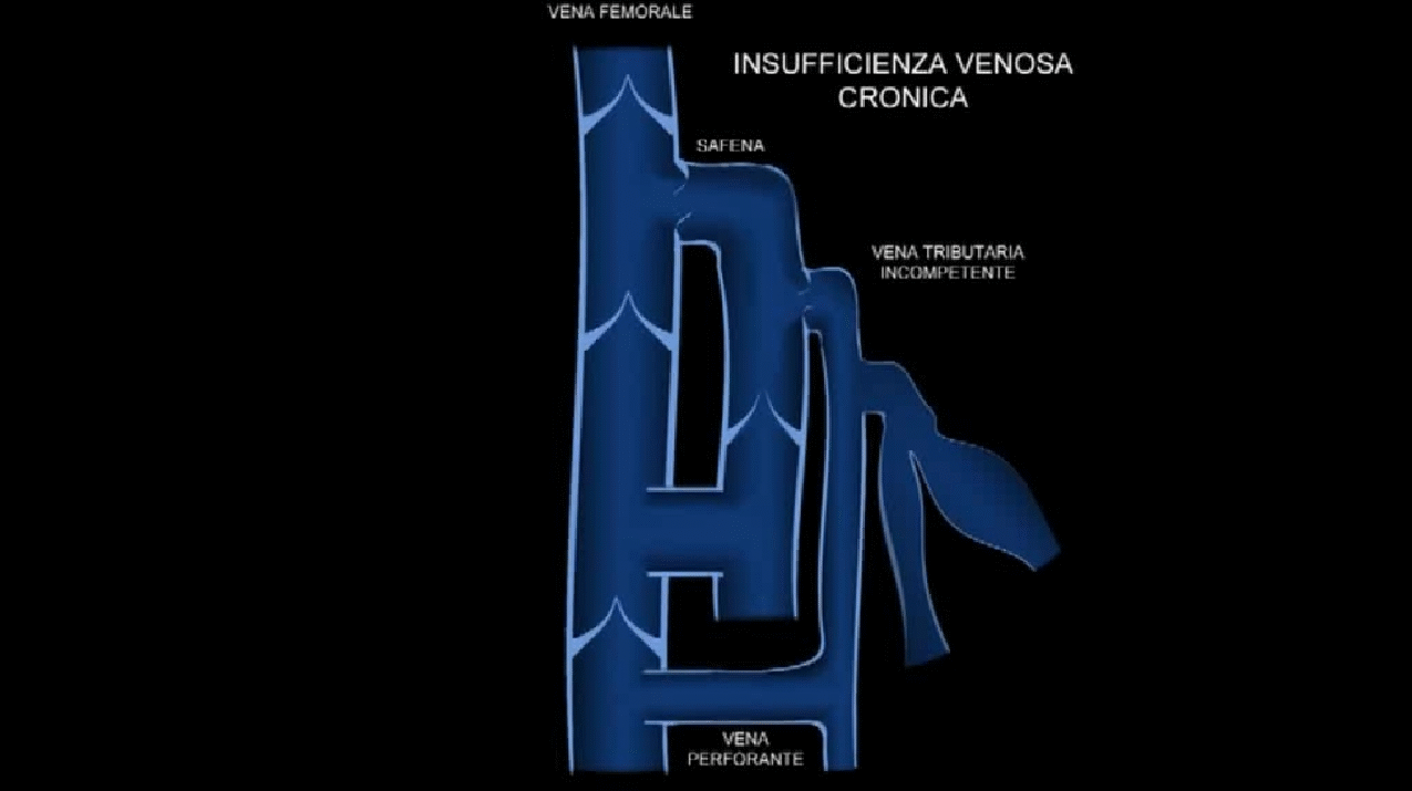 insufficienza-venosa-cronica