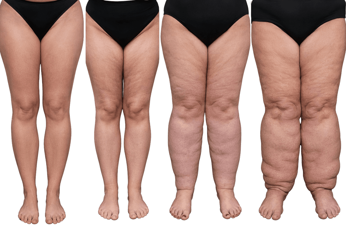 Stadi del lipedema: sproporzione tra tronco e arti, non semplice sovrappeso.