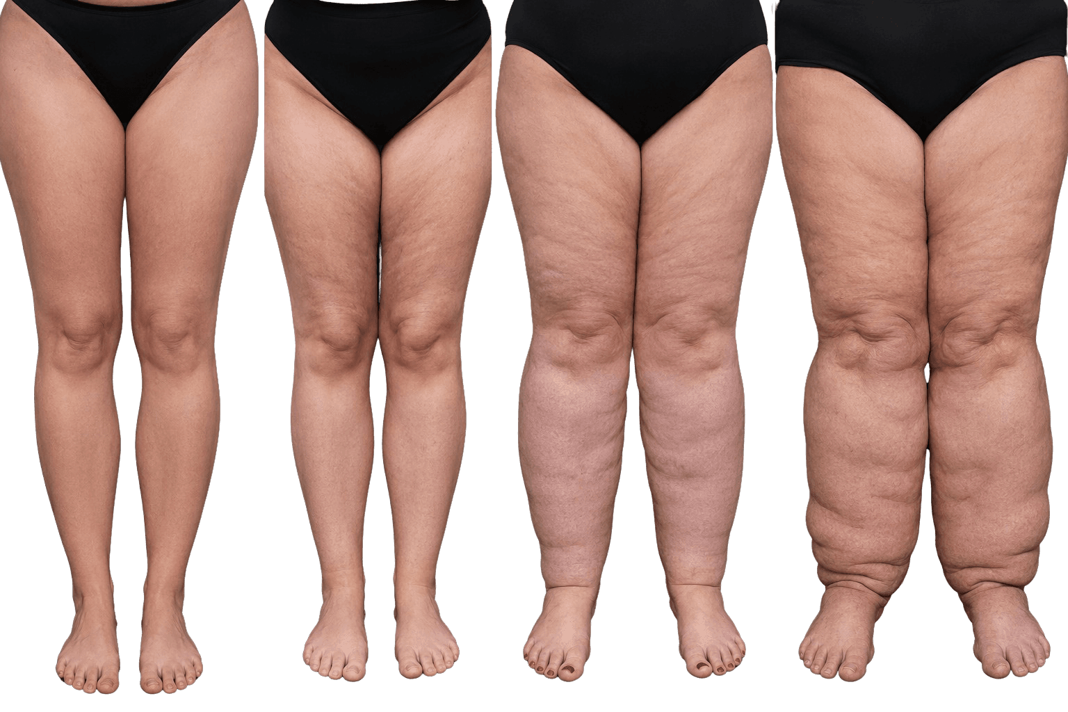 Stadi del lipedema: sproporzione tra tronco e arti, non semplice sovrappeso.