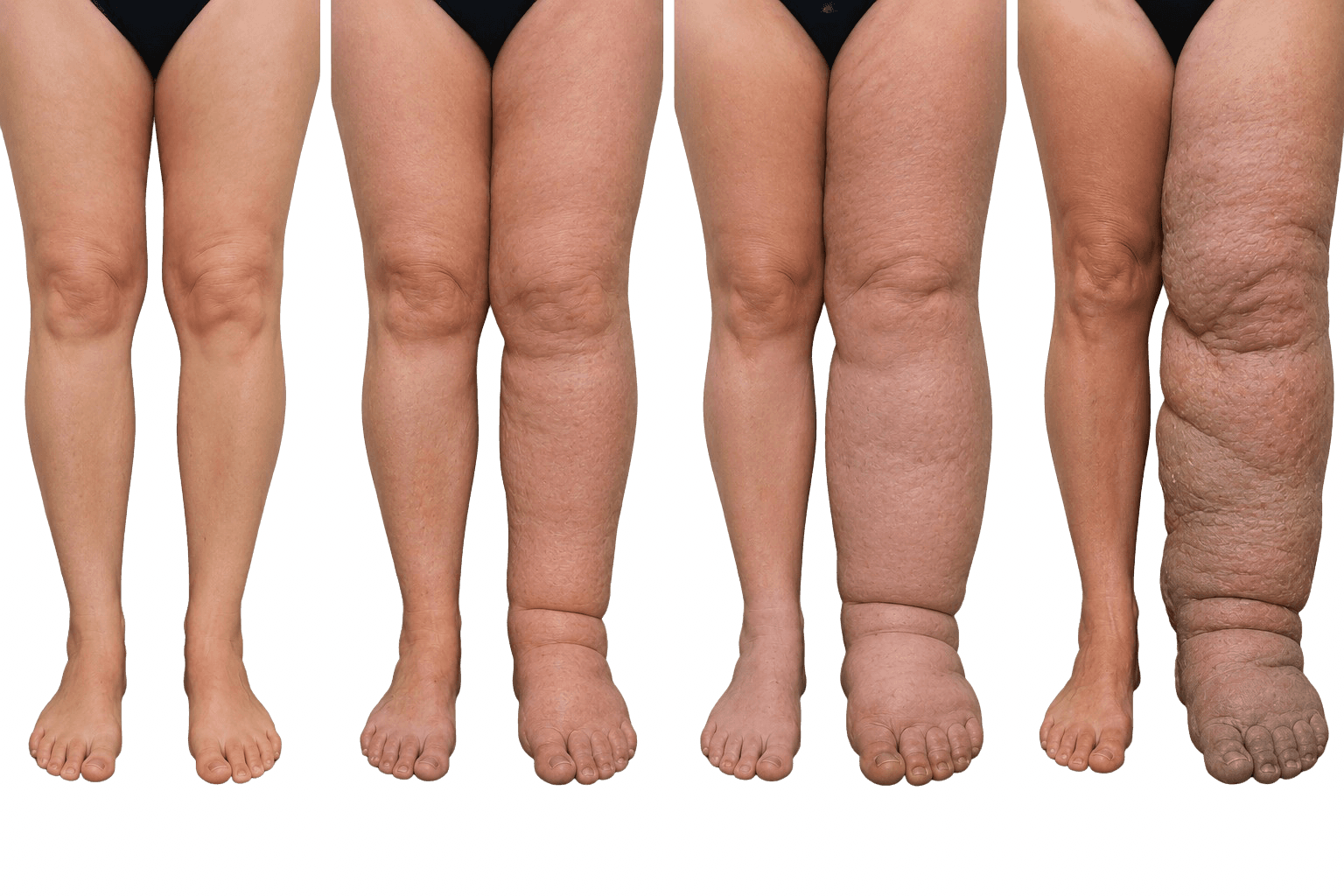 Linfedema: volume, fibrosi e funzione vanno valutati insieme.