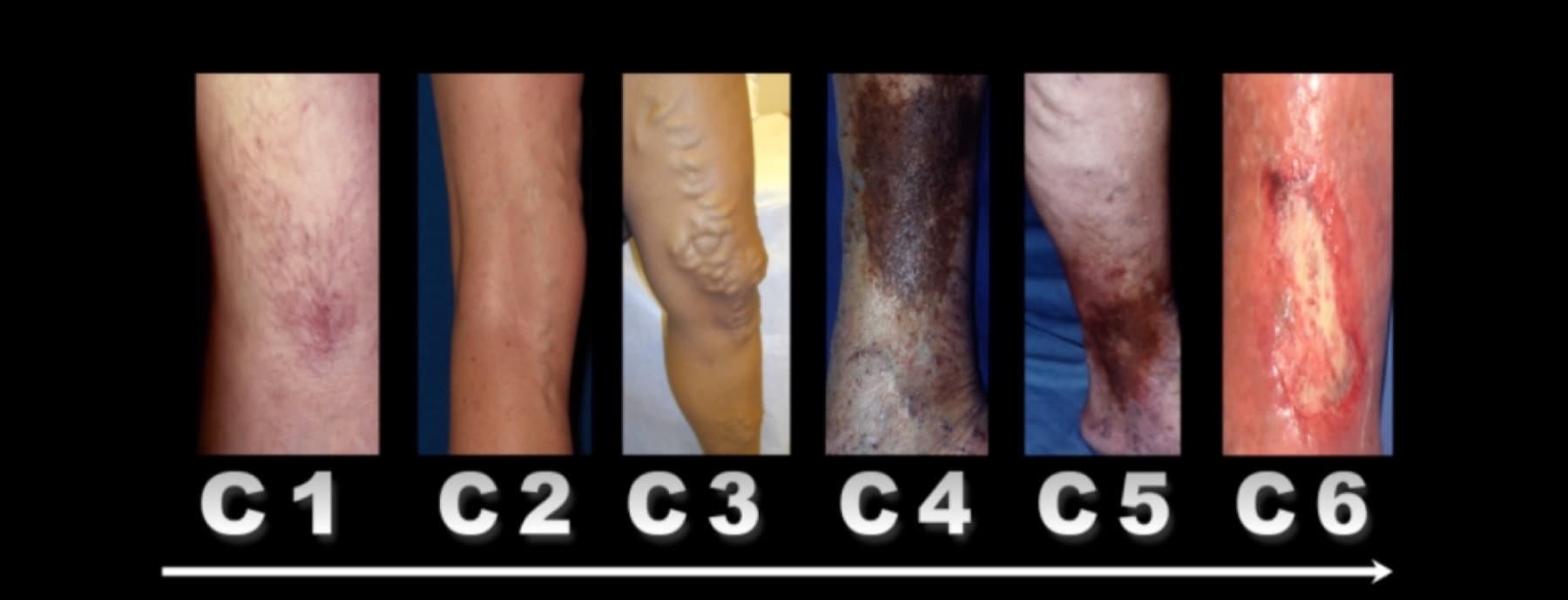 I sei stadi della malattia venosa cronica (classificazione CEAP)